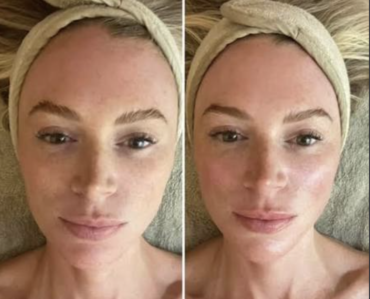 Before and after one session of buccal and lymphatic sculpting